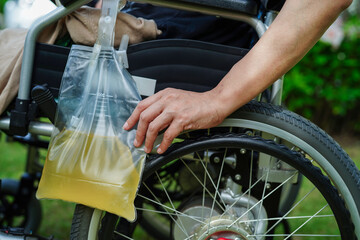 Asian disability woman with urine bag on wheelchair.