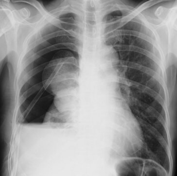Right Hydropneumothorax  chest x ray