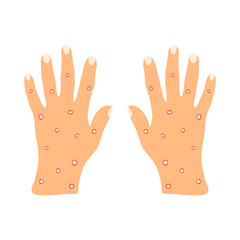 Monkeypox symptoms, hand skin rashes, blisters and purulent formations. Skin disease caused by a virus, chicken pox, acne, pustule in flat style isolated on white background