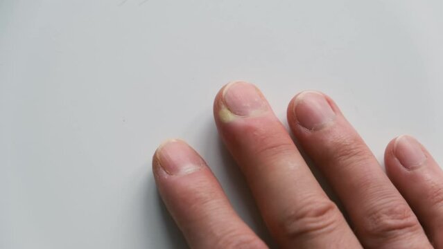 Swollen finger on a white background. The distal phalanx of the finger exhibits swelling due to acute paronychia. An infection of the cuticle