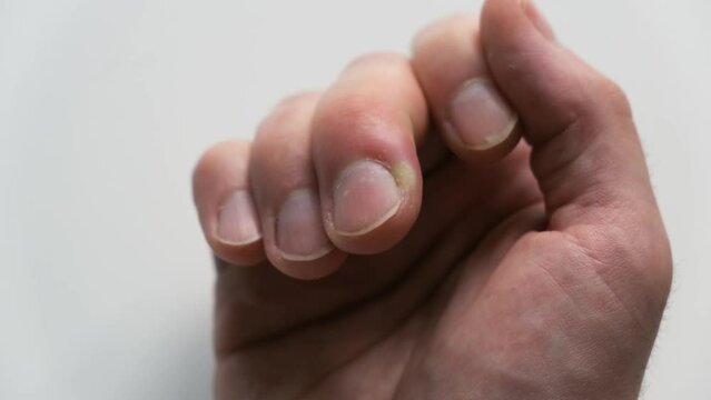 Swollen finger on a white background. The distal phalanx of the finger exhibits swelling due to acute paronychia. An infection of the cuticle