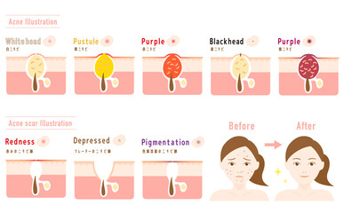 ニキビとニキビ跡 皮膚断面図 女性のビフォーアフター