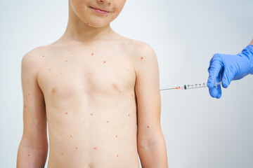 Young boy having chickenpox pictures of skin