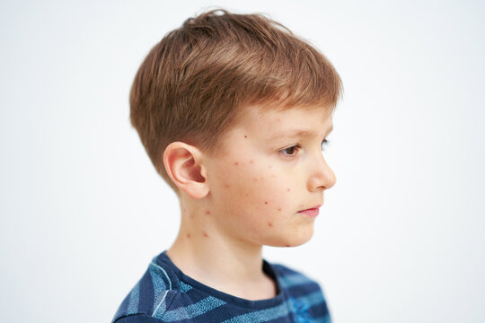 Young boy having chickenpox pictures of skin