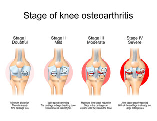 Stages of knee osteoarthritis