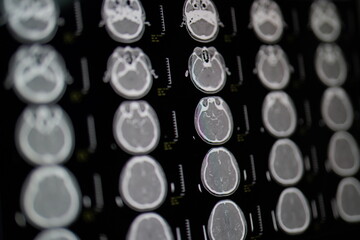 CT angiography of brain scan for rule out stroke