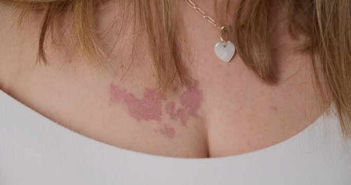 Below neck view of girl pulling down neck of her camisole exposing burn mark on her upper chest. Close up.