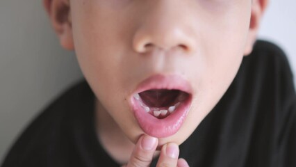 Asian kid showing the bent baby milk tooth with new grow teeth from behind as a mouth and dental care concept.