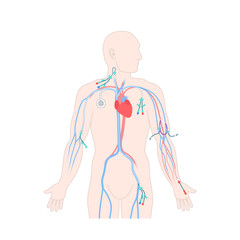 Central venous catheter placement sites shown on the male body. Types of central lines. Man with CVC access devices. PICC, arterial line, implantable port for infusion. Medical vector illustration.