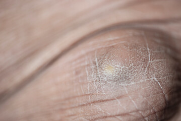 Fototapeta premium scars on the skin of a person's body