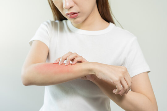 Dermatology asian young woman, girl allergy, allergic reaction from atopic, insect bites on her arm, hand in scratching itchy, itch red spot or rash of skin. Healthcare, treatment of beauty.