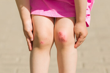 Toddler girl showing abrasion knee skin. Child after fell down. Closeup. Front view.