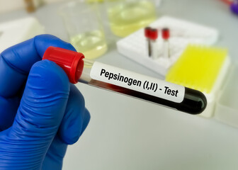 Obraz premium Scientist hold blood sample for Pepsinogen (I,II) test, diagnosis for early detection of gastric cancer. PG I,PG II.