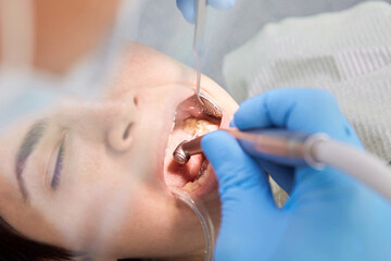 Close up Portrait Of Female Patient Having Terrible Toothache. Dentist Curing Teeth Cavity In Blue Gloves.