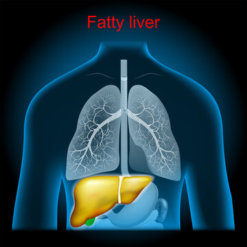 Fatty liver disease. Hepatic steatosi