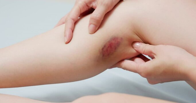 bruise on the patient leg