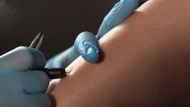 dermatologist performs a hair removal procedure on a patient's leg using electrolysis. Depilation and beauty concept. The doctor works in a cosmetic medical office. permanent hair removal