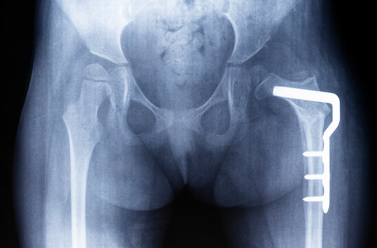 Osteotomy of the hip joint. Film radiograph of the pelvis shows dysplasia of the left thigh, metal plate.