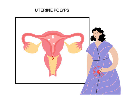 Uterus Polyps Disease