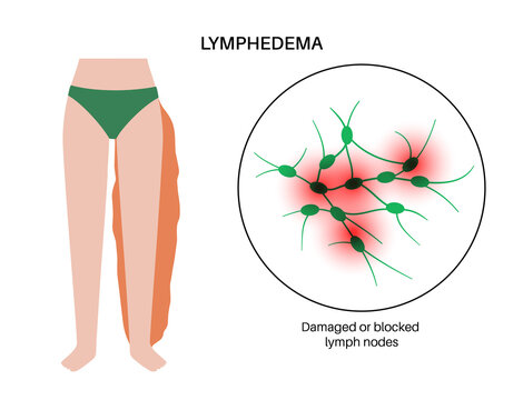 Lymphedema leg swelling