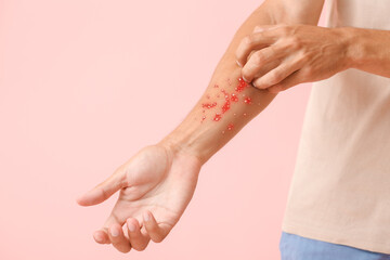 Man ill with monkeypox scratching his arm on pink background