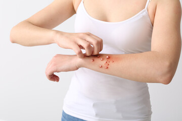 Woman ill with monkeypox on light background, closeup