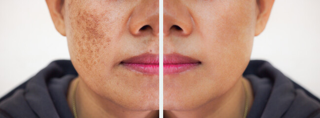 Problem skincare and health concept.Wrinkles,melasma,Dark spots,freckles,dry skin on face middle...