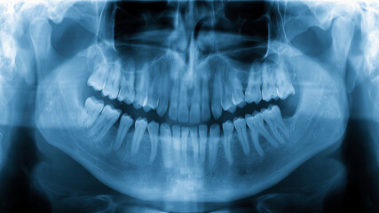 X-ray radiograph picture showing human jaw and teeth