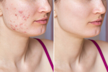 Cropped shot of young woman's face before and after acne treatment on face. Pimples, red scars on...