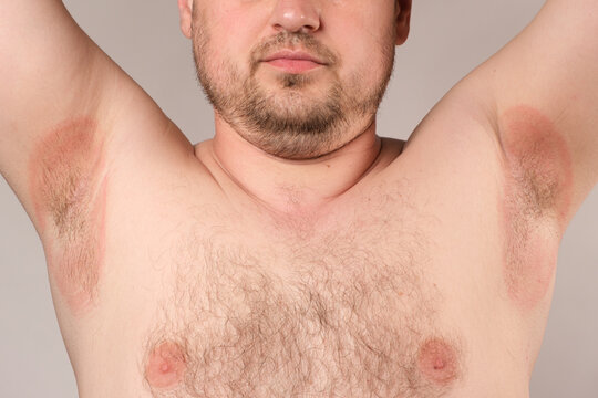 Redness of the armpits in a man - inflammation or prickly heat, red spots of the armpits.