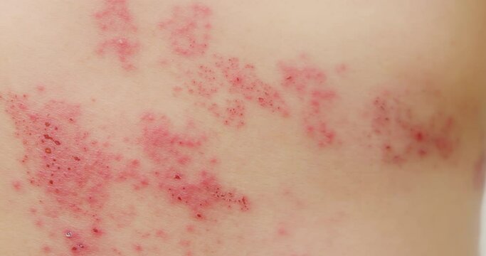 man with shingles disease