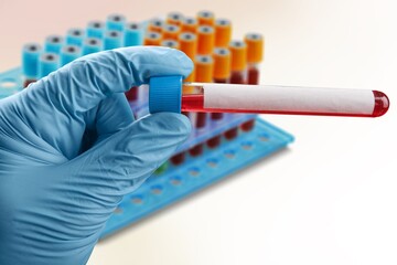 Blood sample tube for virus test. It is also known as the Moneypox virus,