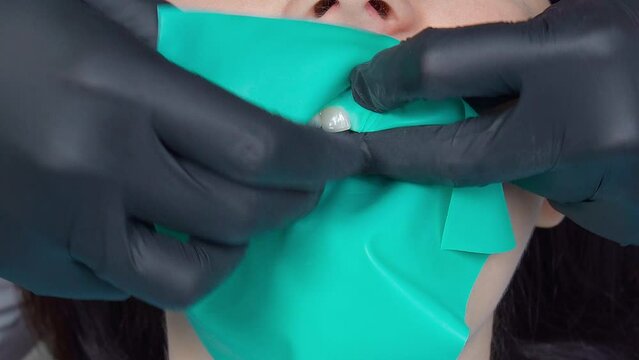 The doctor and the assistant install a green cofferdam in the patient's mouth. The dentist and his assistant help the patient. Patient care for caries and brushing teeth