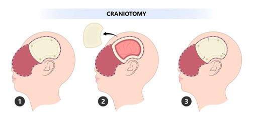 Brain cancer tumor and burr hole skull bone flap fluid head post sport accident cysts deep stimulation Parkinson's confusion