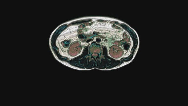 Bulk multicolored CT scan of the abdomen. Computed tomography of the gastrointestinal tract, liver and kidneys