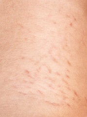 Fototapeta premium Skin with stretch marks on a woman's body close-up.Treatment of skin stretch marks in the clinic.