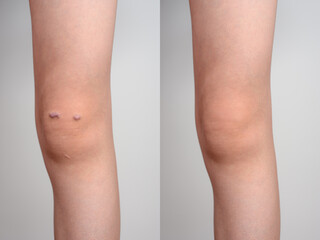 Knee of a girl with keloid scar, before and after treatment