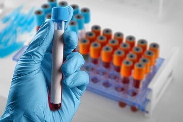 Blood sample of patient for test in laboratory. Doctor with Blood tube test in lab
