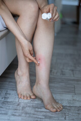 Woman sitting on bed at home, applying cream or balm on swollen skin leg from mosquito or midge bites, suffering from allergic reaction and swelling, itchy sore. Individual intolerance to insect bites