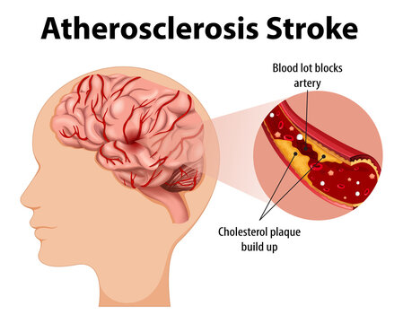 Human anatomy with atherosclerosis stroke