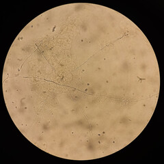 Microscopic view of hyphae of dermatophytes. fungus test. skin scraping, Diagnosis for fungal...