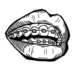 Braces on the teeth. Medical dentist checkup in dental clinic. Tooth correction with brackets. Open mouth showing healthy teeth and gums. Hand drawn retro vintage illustration. Old style drawing.