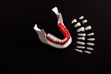Teeth implant and crown installation process parts isolated on a black background. Medically...