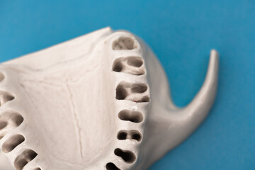 Upper human jaw without teeth model medical implant isolated on blue background. Healthy teeth, dental care and orthodontic concept.