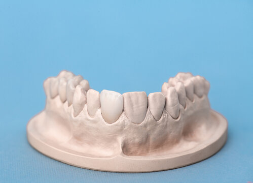 Gypsum model of human jaw with teeth on a blue background.