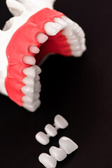 Teeth implant and crown installation process parts isolated on a black background. Medically accurate 3D model. 