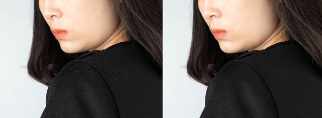 Before and after treatment dandruff and seborrheic dermatitis. Long black hair woman looking at hair flakes on her shoulder. Hair care concept. - obrazy, fototapety, plakaty