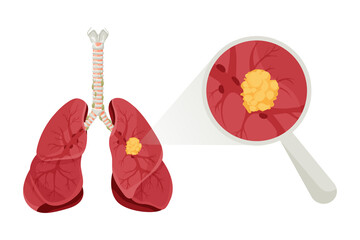 Diagram lung cancer disease. Concept disease human internal organs. Vector illustration, cartoon style.