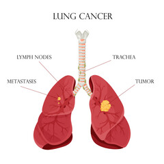 Diagram lung cancer disease. Concept disease human internal organs. Vector illustration, cartoon style.