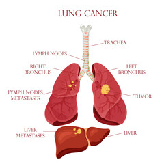 Diagram lung cancer disease. Concept disease human internal organs. Vector illustration, cartoon style.